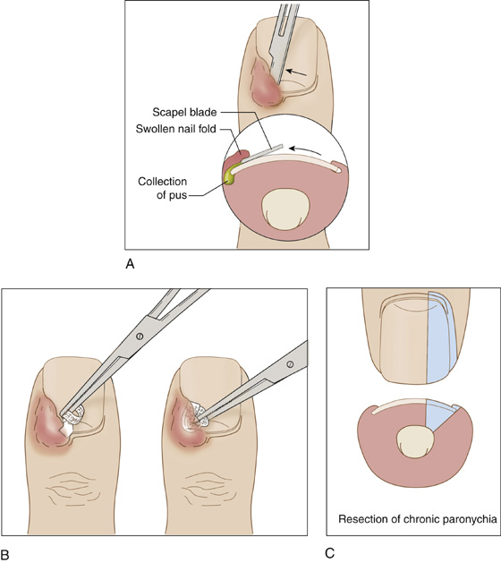 paronychia drainage