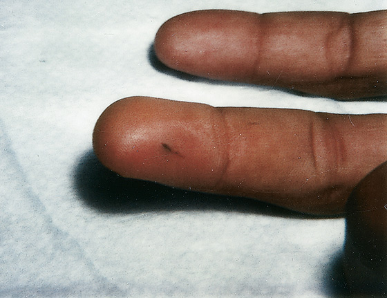 Tinea Pedis, Tinea Cruris, Tinea Corporis (Athlete's Foot, Jock