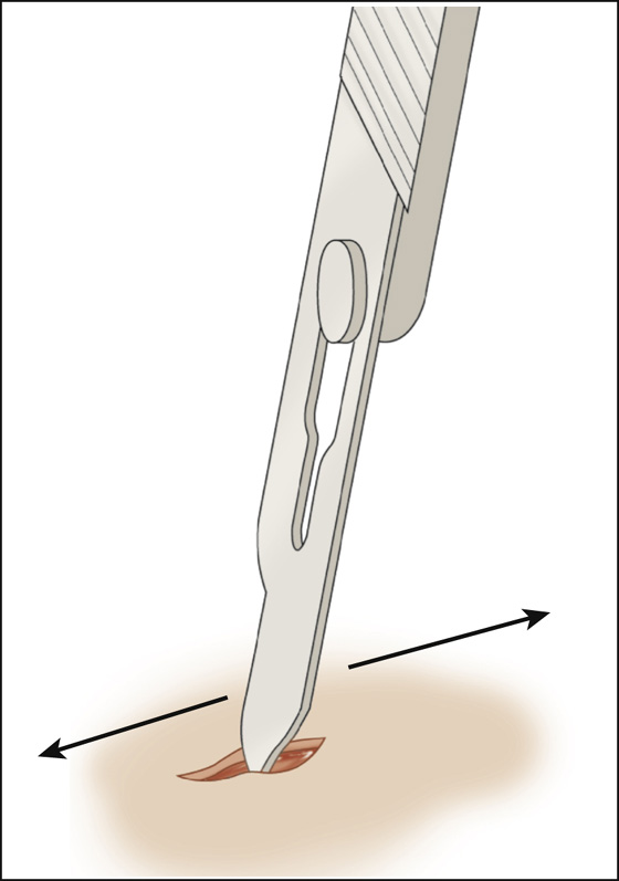 Tinea Pedis, Tinea Cruris, Tinea Corporis (Athlete's Foot, Jock