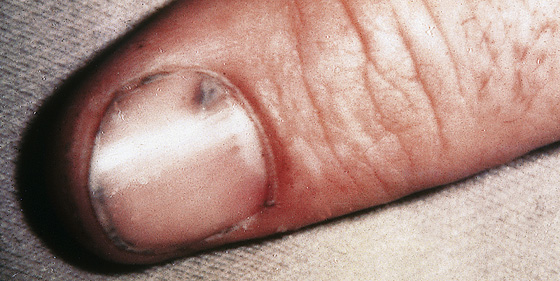 Subungual Ecchymosis (Tennis Toe)