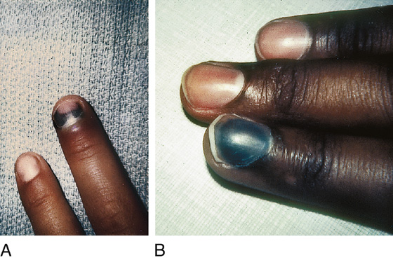 Subungual Hematoma Drainage