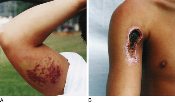 Skin Necrosis, Diffuse Urticaria, and Cellulitis Due to Presumed Loxosceles Spider  Bite - ScienceDirect