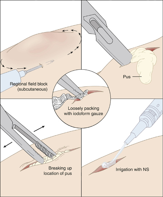 skin abscess drain