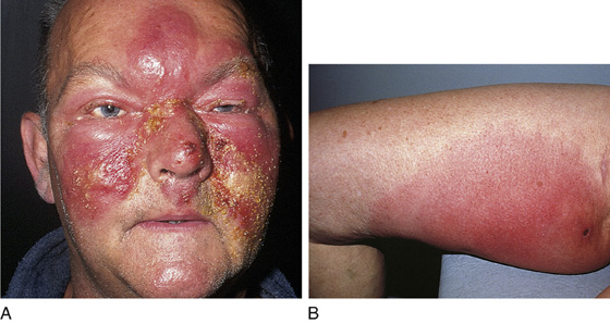 erysipelas vs cellulitis