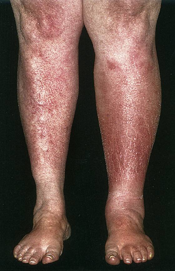 erysipelas vs cellulitis