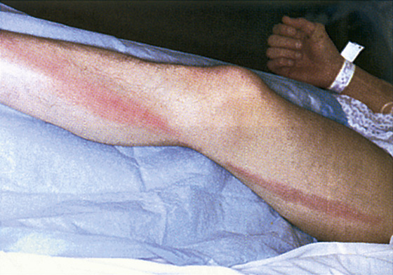 Erysipelas Cellulitis Lymphangitis Anesthesia Key 