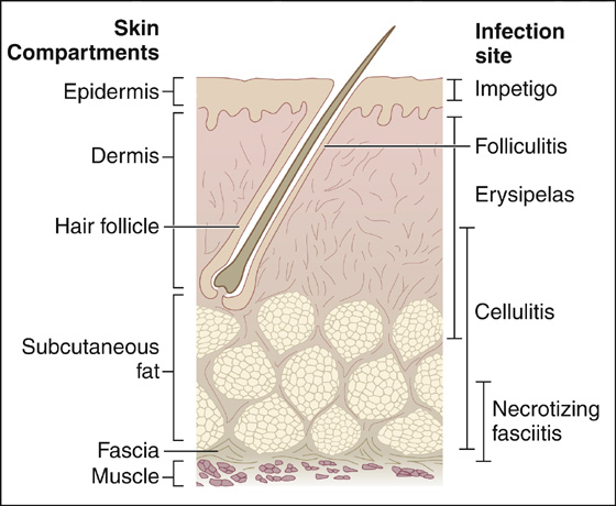 erysipelas vs cellulitis