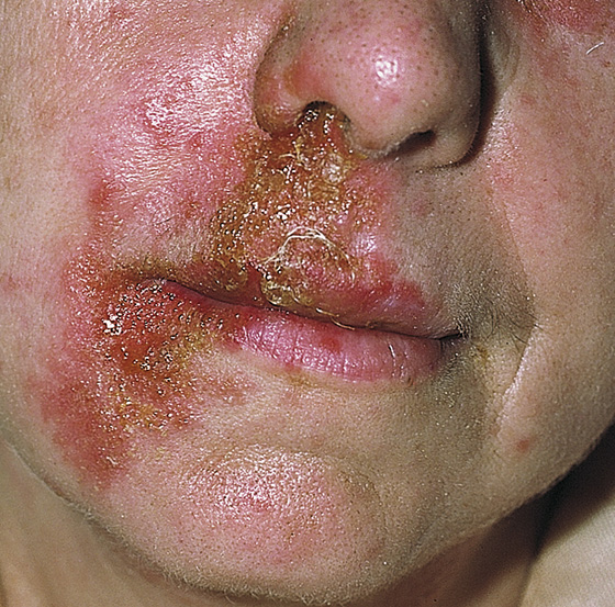 impetigo in children face