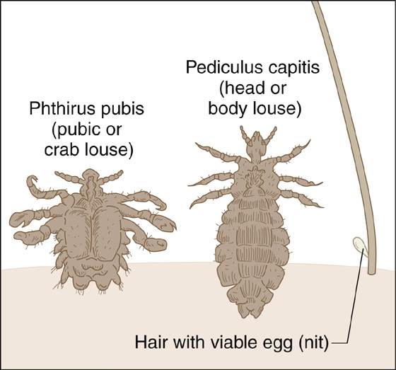 Pediculosis Pubis Crabs