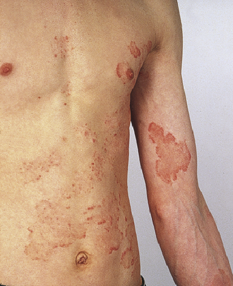 Tinea unguium Fig 10: Tinea corporis and tinea unguium) (Ringworm of