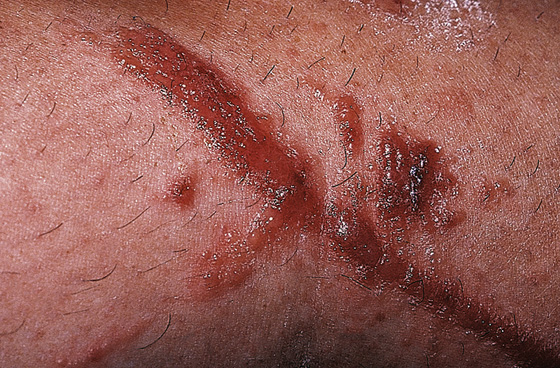 Tinea Pedis, Tinea Cruris, Tinea Corporis (Athlete's Foot, Jock Itch,  Ringworm)