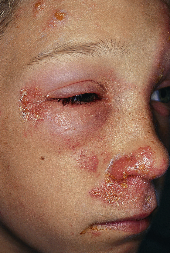 minor poison ivy rash on face