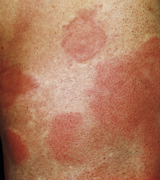 Acute Urticaria Rash 