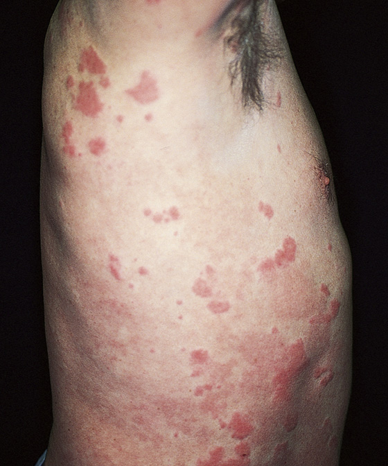 Urticaria Acute Hives