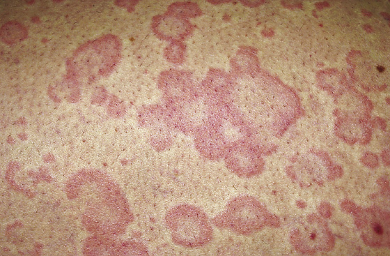 Urticaria Acute Hives