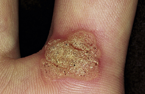 black warts on hands