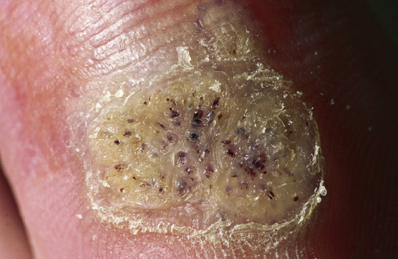 wart on foot with black dots)