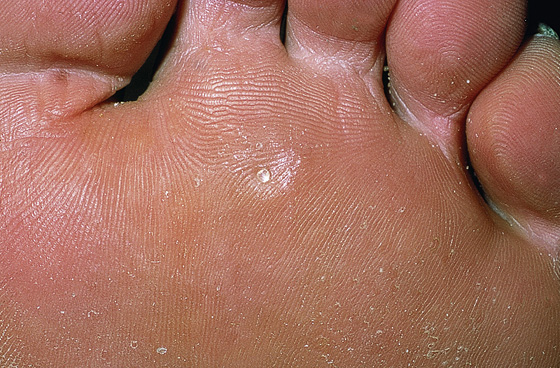 wart on foot white