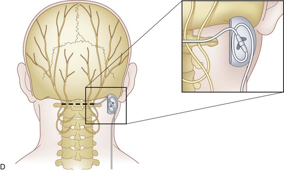 Complications Of Cranial Nerve Stimulation Anesthesia Key