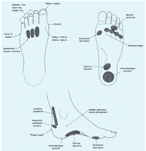 Approach to Common Problems of the Foot and Ankle | Anesthesia Key