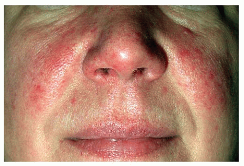 4 142 1 Rosacea With Conjunctivitis Ce4