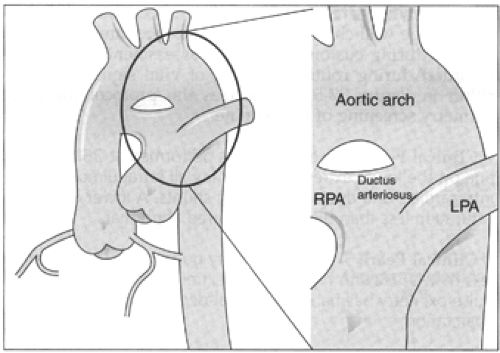 interrupted aortic arch vsd