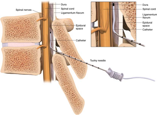 epidural site pain years later