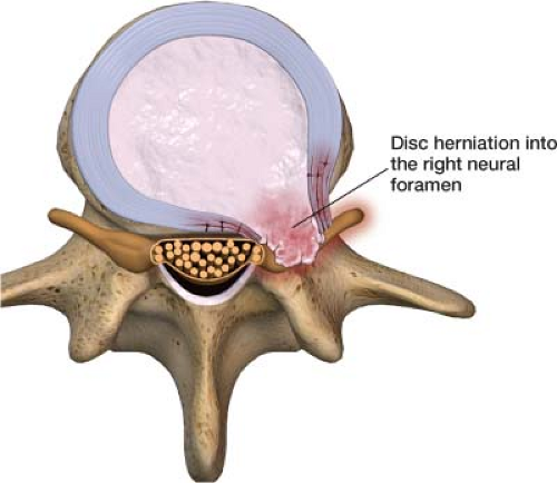 how do oral steroids help herniated disc