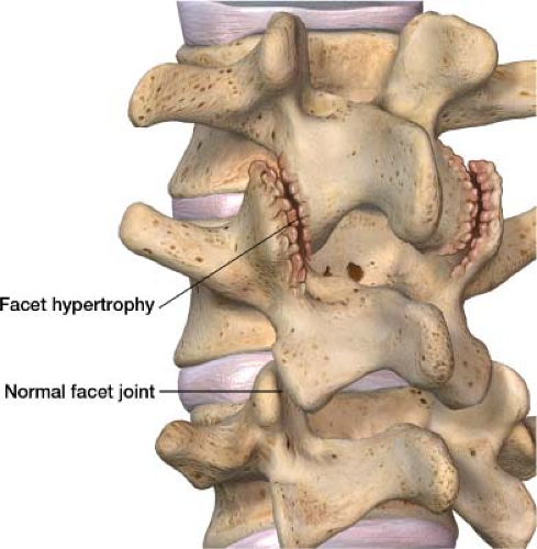 vertebral facet