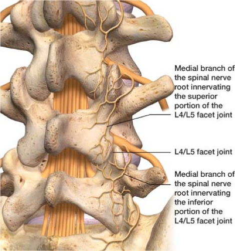 spinal facet injections