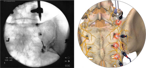 Facet Joint Procedures: Facet Joint Injections, Medial Branch Blocks ...