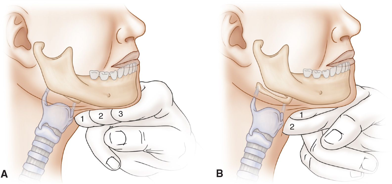 Intubation Tracheal And Nasotracheal Anesthesia Key