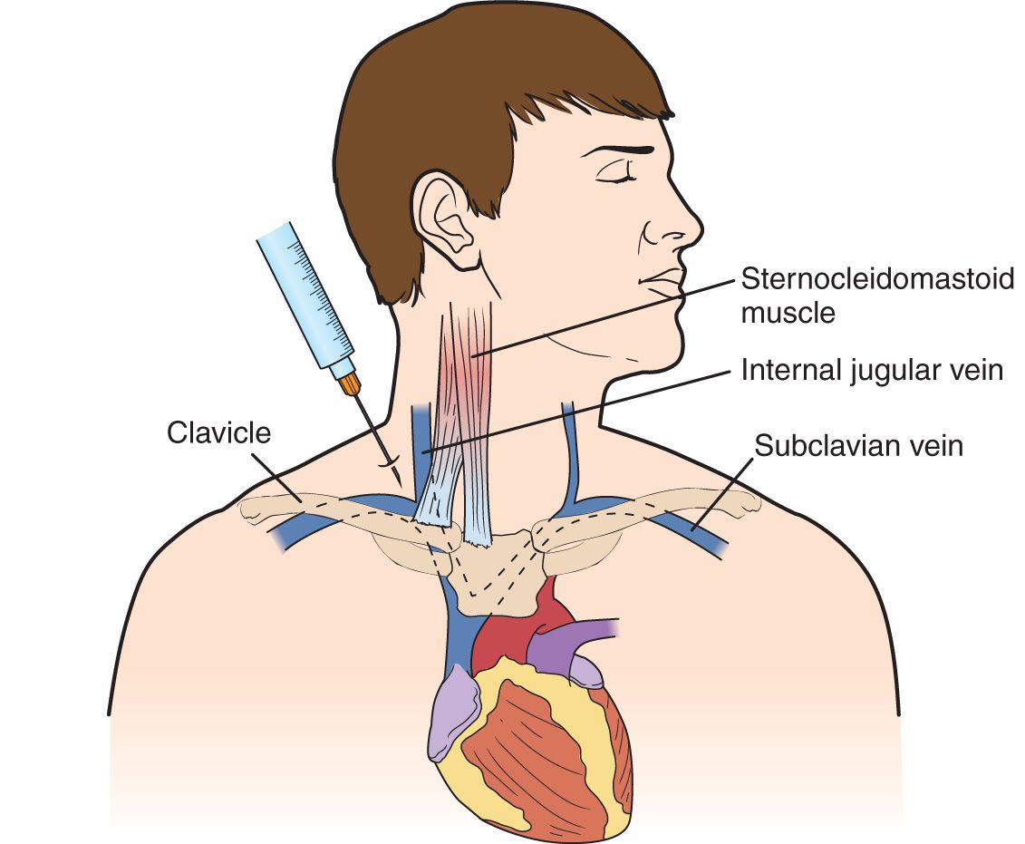 central venous catheter subclavian