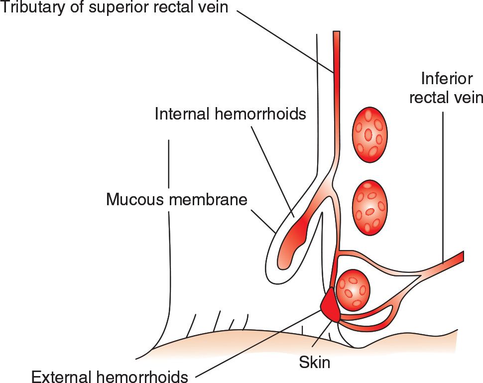 thrombosed hemorrhoid excision