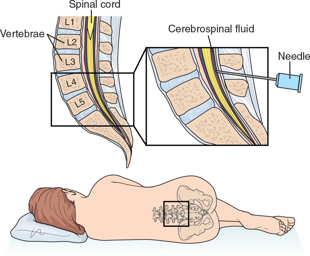 lumbar-puncture-opening-pressure