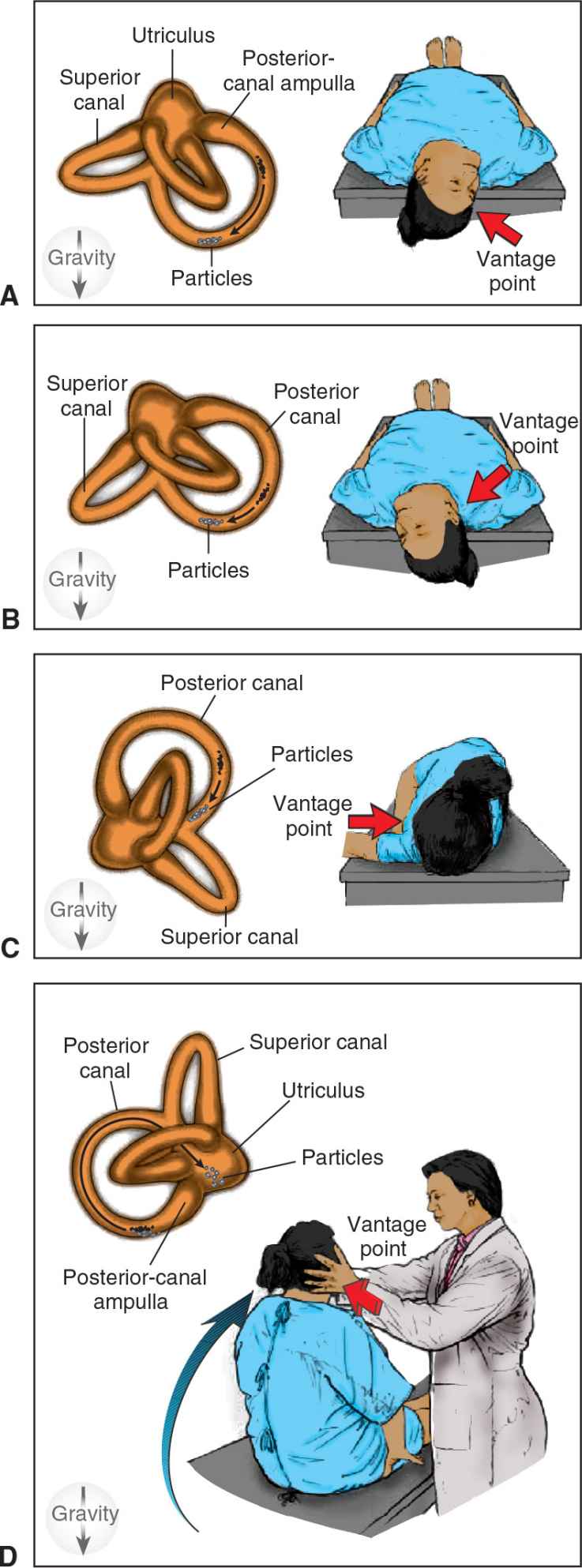 Epley Maneuver Dix Hallpike Epley Maneuver Dix Hallpike