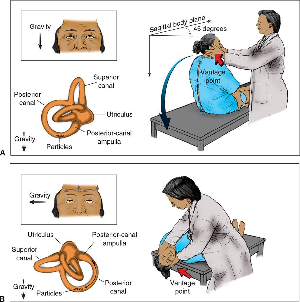 Hallpike Test Dix Hallpike Nylan Barany Anesthesia Key 