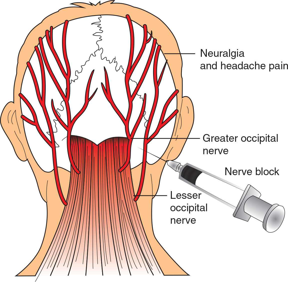 What happens if the occipital nerve is cut?