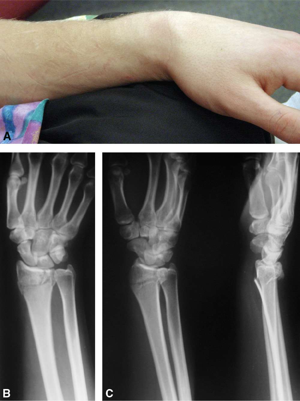 colles fracture vs smith fracture x ray
