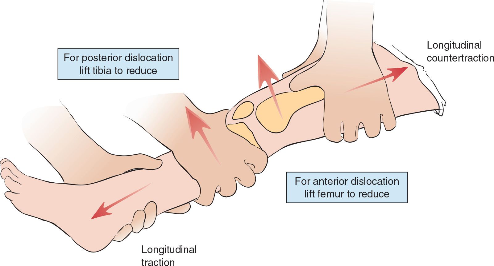 lateral knee dislocation