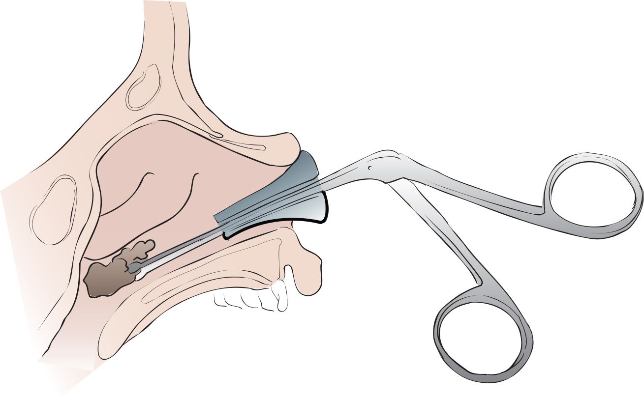 nasal-foreign-body-removal-anesthesia-key