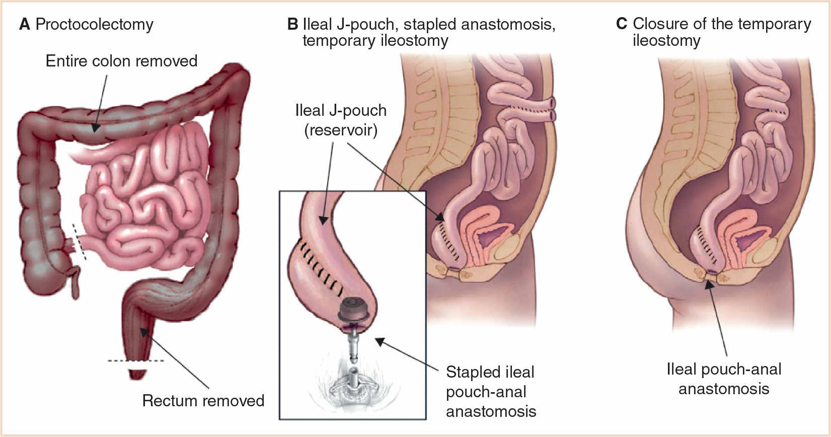 Ileal Pouch Anal Anastomosis (IPAA) Reconstruction after