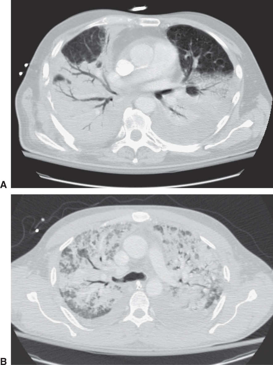 icd 10 dx code for pneumoperitoneum