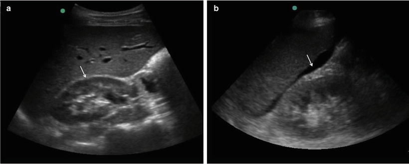 ultrasound trauma basic hepatorenal fig key quadrant
