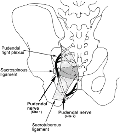 Pudendal and Other Nerve Damage - Posterior Femoral Cutaneous, Ileoinguinal  and Obturator in the Transvaginal Mesh Patient