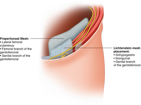 Mesh Removal For Chronic Pain A Review Of Laparoscopic And Open