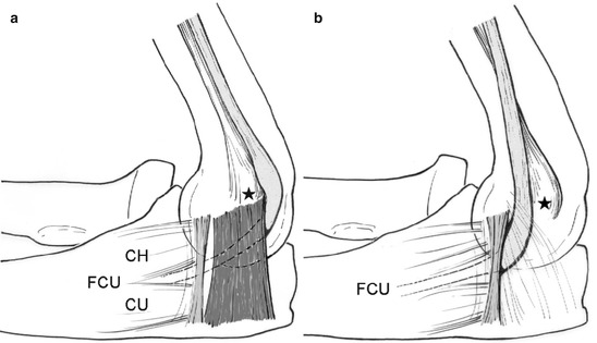 The Controversial Pain Syndrome of GE: Pathogenesis and Surgical ...