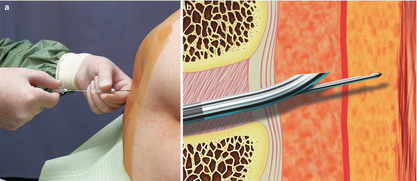 combined-spinal-and-epidural-anesthesia-cse-anesthesia-key