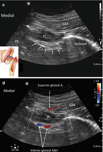 Injection For Piriformis Syndrome | Anesthesia Key