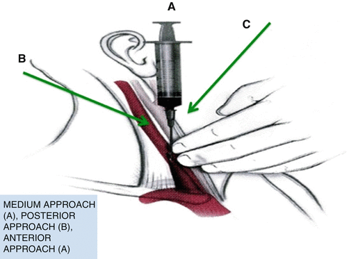 Percutaneous Interventions | Anesthesia Key